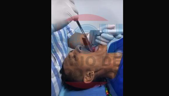 Hombre cometió grave error mientras pescaba y los médicos le extrajeron un pez vivo de la garganta